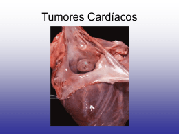 Tumores Cardíacos