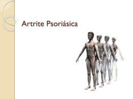 Artrite Psoriásica - Universidade Castelo Branco