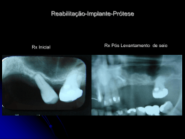 Unitárias-Dente-Implante - APCD – Regional Piracicaba