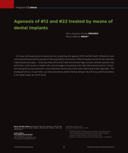Agenesis of #12 and #22 treated by means of dental implants