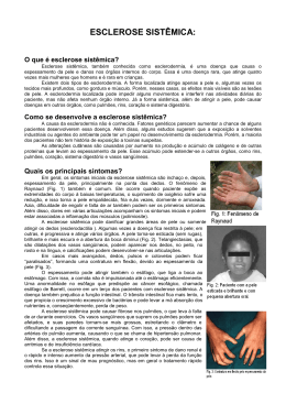 ESCLEROSE SISTMICA - Sociedade de Reumatologia do Rio