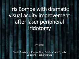 Iris Bombe with dramatic visual acuity improvement after laser