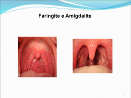 Faringite e Amigdalite Estreptocócica