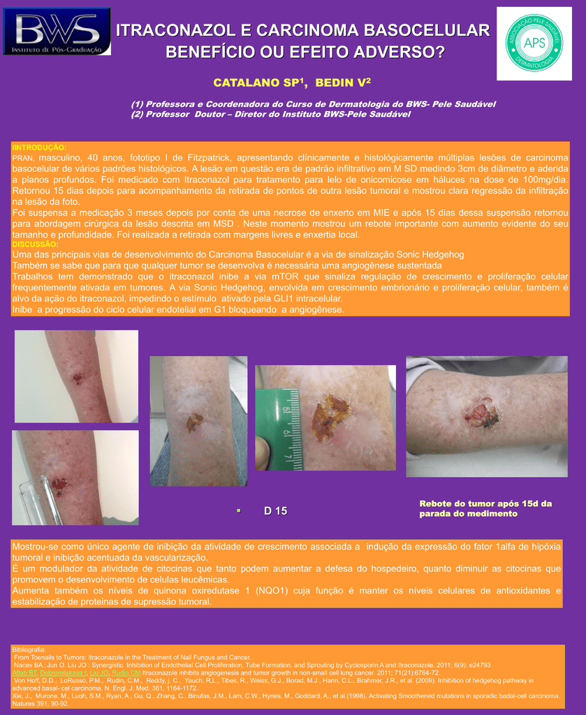 cáncer de próstata de itraconazol cáncer de próstata de itraconazol