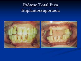 Pr&oacute;tese Total Fixa Implantosuportada