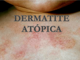 dermatite atópica